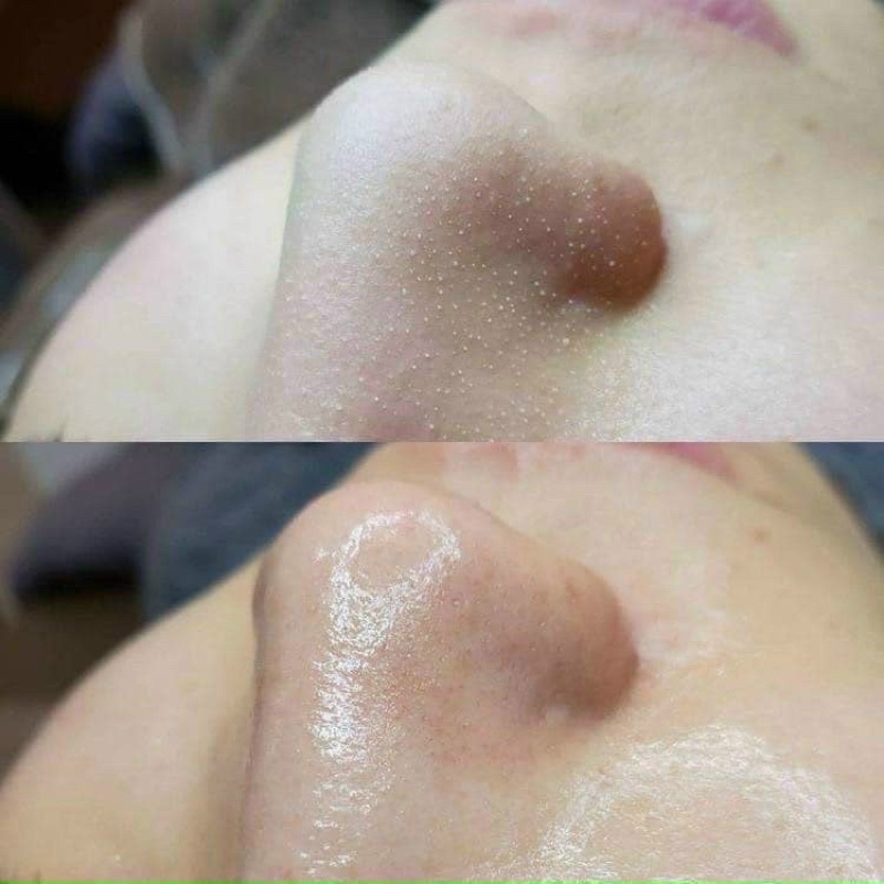 Ủ Mũi Xử Lý Mụn đầu đen Removes Blackheads 50ml