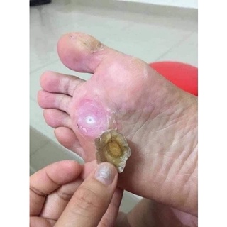 [HÀNG THÁI] KEM CHẤM MỤN CÓC,MUN RUOI, MUN THIT THÁI LAN