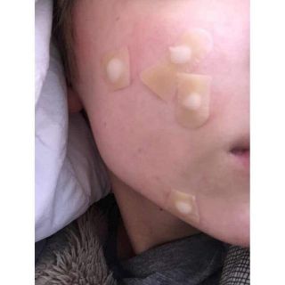 ❤️ Tặng kim Lancets . Miếng dán mụn Duoderm extrathin