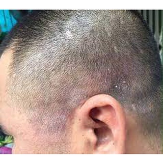 Gội Gàu Nấm DR CELL