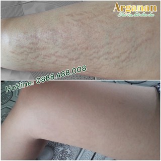 Dầu trị rạn Arganan (1 hộp)