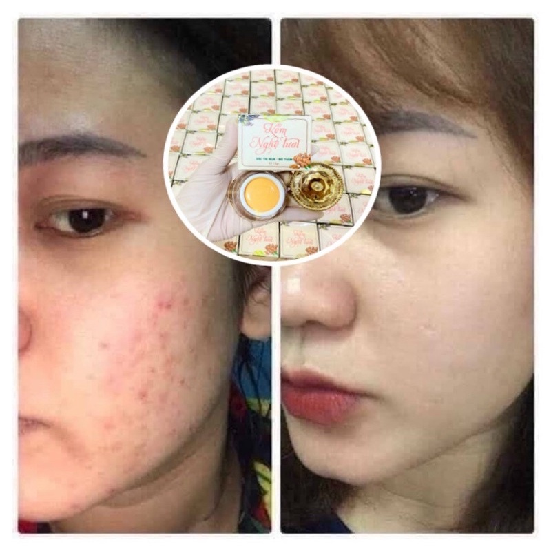 KEM FACE NGHỆ TƯƠI 15gram