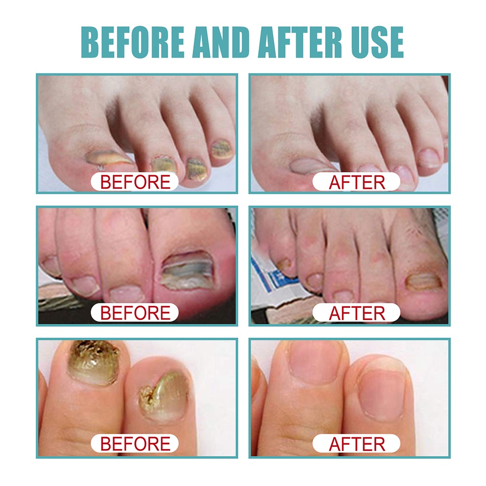 Eelhoe 10ml Nail sửa chữa nuôi dưỡng giữ ẩm chống-barb nấm giải pháp chăm sóc