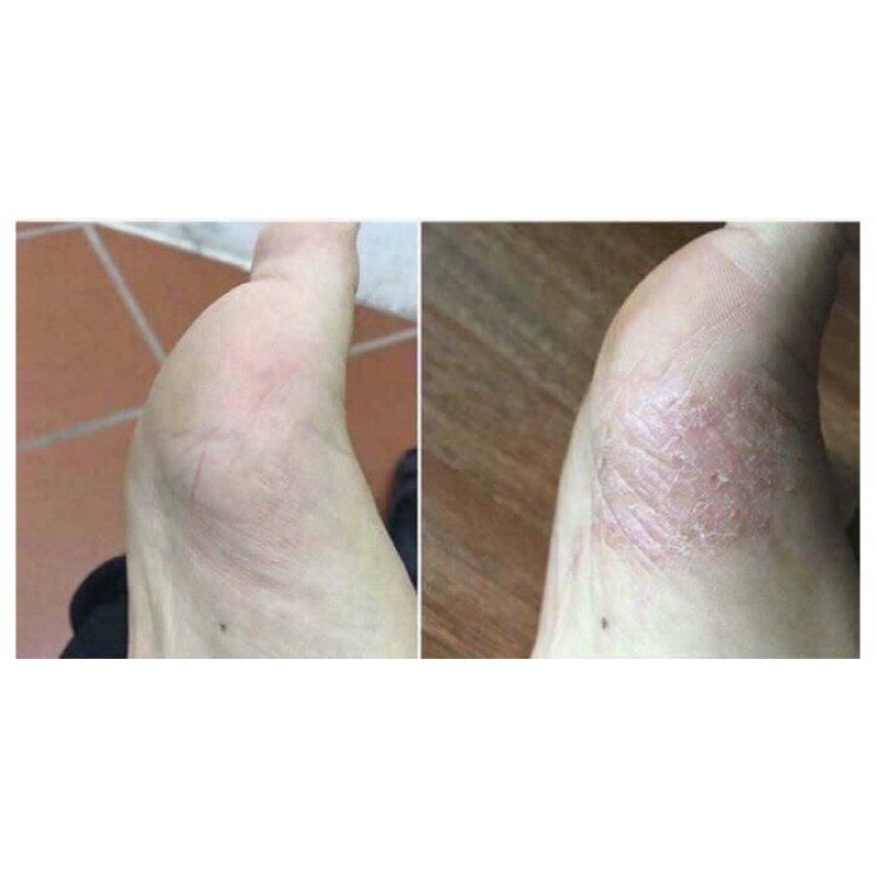 [CHỈ BÁN HÀNG THÁI] KEM VẢY NẾN,Á SỪNG,VIEM DA THÁI LAN[SẴN][FREESHIP][CHUẨN HÀNG][BẢO HÀNH 7 NGÀY] | BigBuy360 - bigbuy360.vn