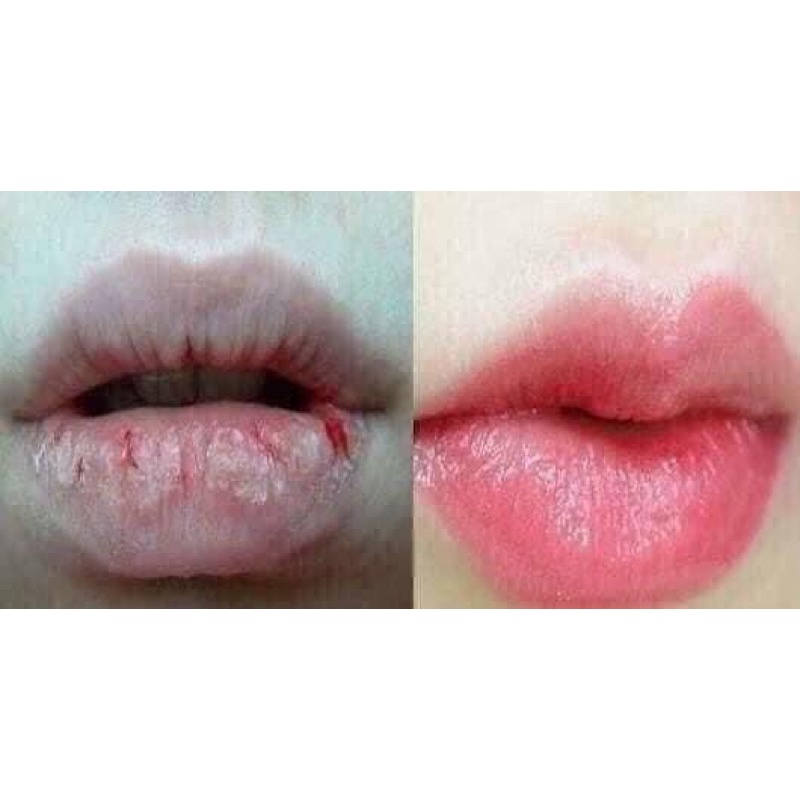 Dưỡng Hồng Môi, Giảm Thâm Môi Lips Care Thái Lan