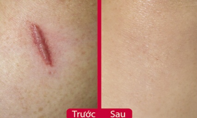 Rejuvasil scar gel 30g kem hỗ trợ giảm sẹo lồi, sẹo phẫu thuật lâu năm