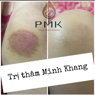 Tinh Chất Mờ Thâm Minh khang( tặng ngay 1 thâm gia truyền 120k)