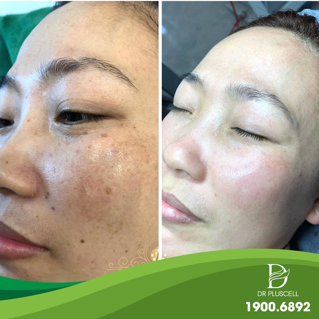 (Mới) Tế Bào Gốc 6GF Dr Pluscell giúp loại bỏ sẹo rỗ,nâng cơ,trẻ hóa và sáng da...