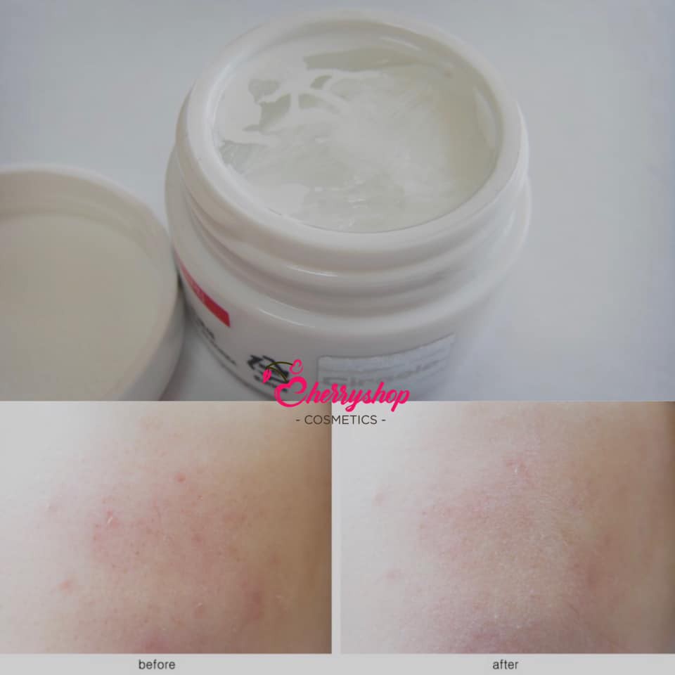 KEM MỤN VÀ VẾT THÂM &quot; - Ciracle Red Spot Cream