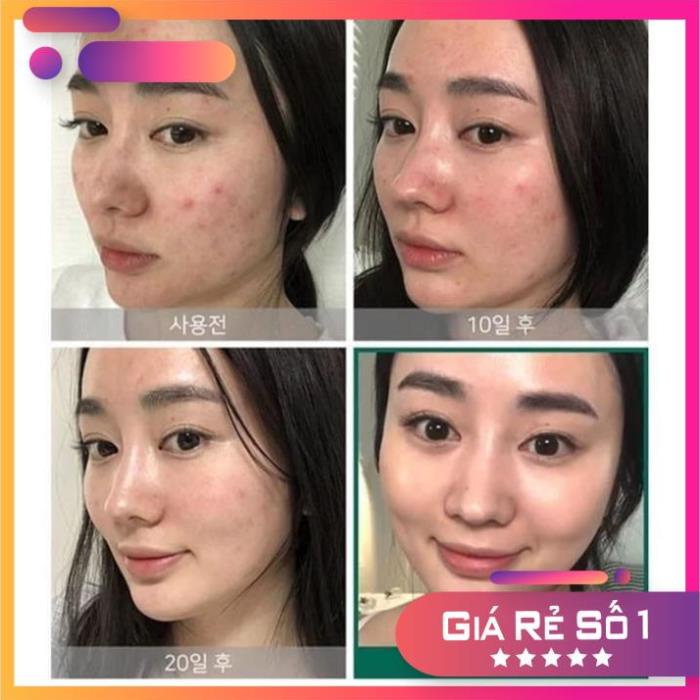31[CHINH HANG] - Nước Hoa Hồng SOME BY MI Cho Da Mụn Miracle Toner AHA- BHA-PHA 30 Days 150ml | BigBuy360 - bigbuy360.vn