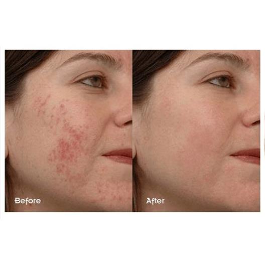 Serum The Ordinary Niacinamide 10% + Zinc 1% Giảm Viêm , Giảm Mụn | BigBuy360 - bigbuy360.vn