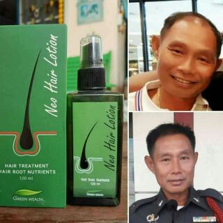 Neo Hair Lotion (Chuyên sỉ)