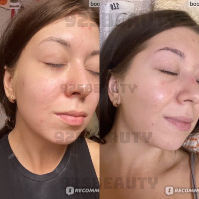 Kem dưỡng cho da mụn Eveline Glycol Therapy 7% ngừa mụn, mờ thâm | BigBuy360 - bigbuy360.vn