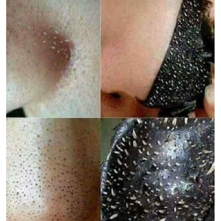 GEL LỘT MỤN THAN TRE