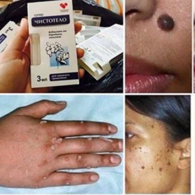 Gel tẩy mụn ruồi, mụn cóc , mụn thịt