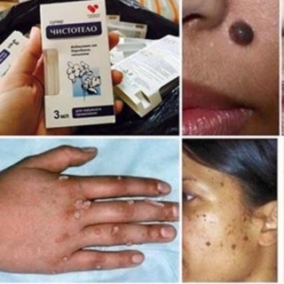 Gel tẩy mụn ruồi, mụn cóc , mụn thịt