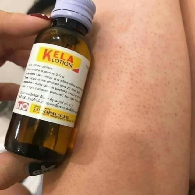 KELA LOTION Thái Lan trị Viêm Lỗ Chân Lông | BigBuy360 - bigbuy360.vn