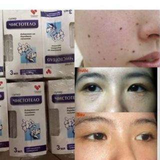 Gel Tẩy Nốt Ruồi,Tàn Nhang, Mụn Cóc, Mụn Thịt.Sẹo Lồi
