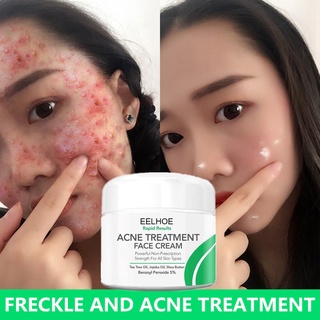 Kem dưỡng ẩm loại bỏ mụn làm trắng da mặt giảm vết thâm sẹo tự nhiên Loại bỏ vết sẹo làm sáng da mặt Kem