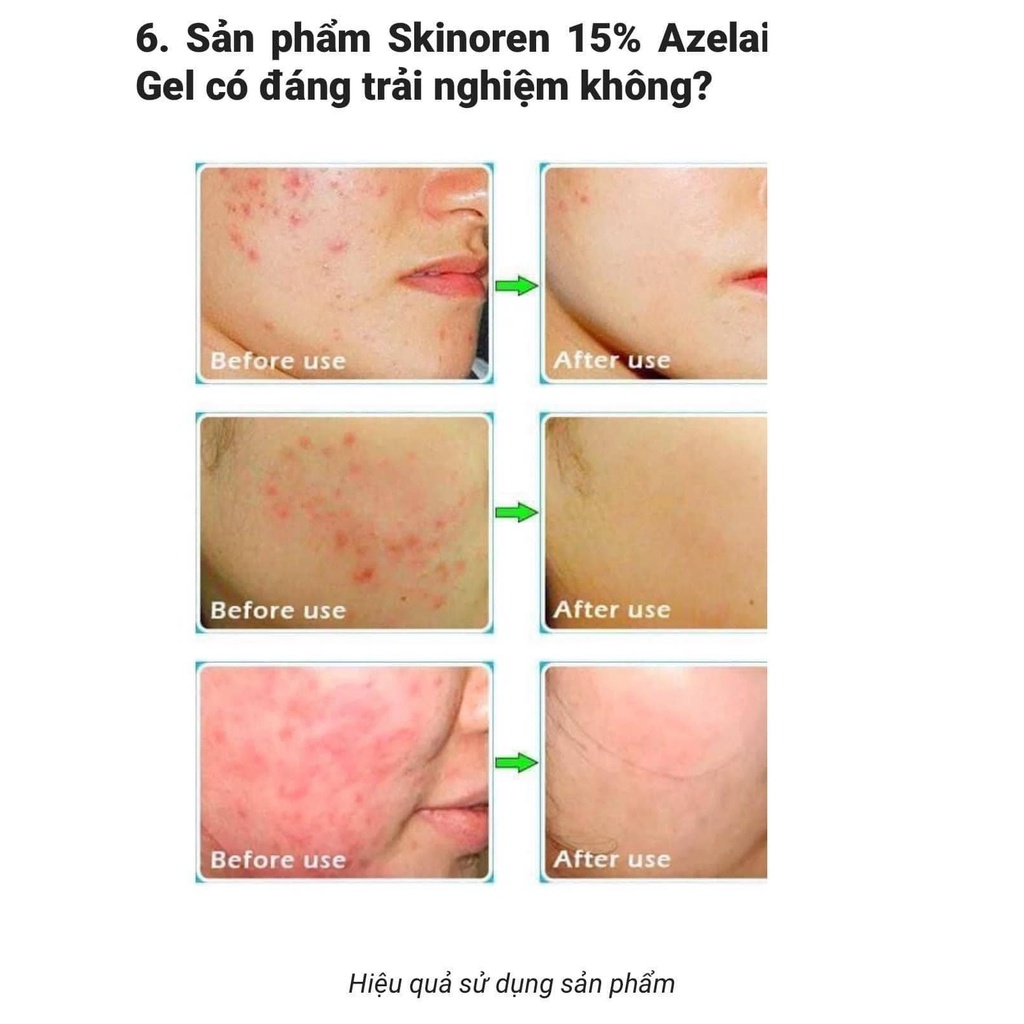 Gel Skinoren Chứa Azelaic Acid - 15g Bản Nga