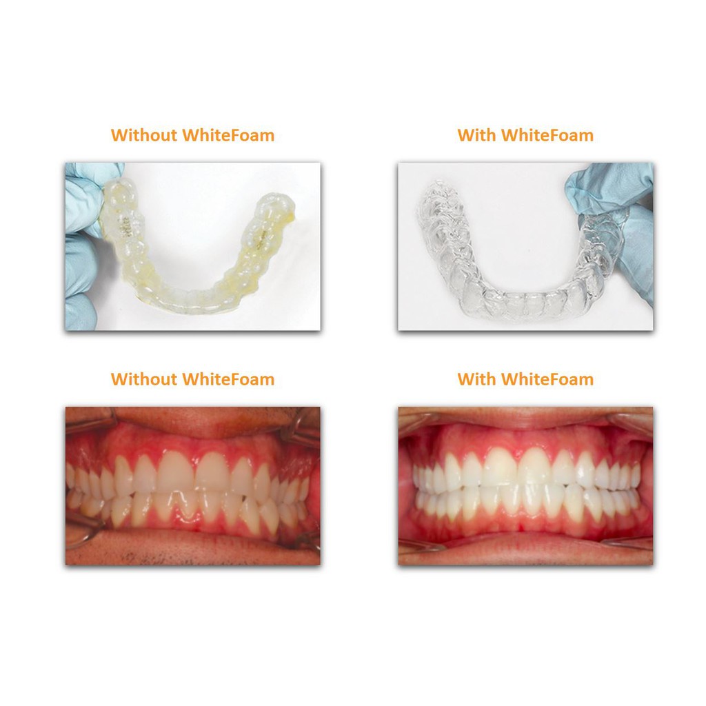 WhiteFoam làm sạch máng chỉnh nha trong suốt như Invisalign