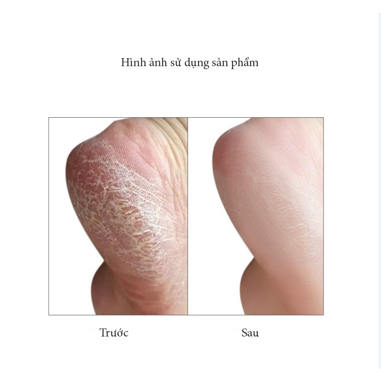 Chà gót chân - Dụng cụ chà gót chân mặt kim loại làm sạch tế bào chết