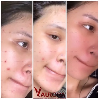 SERUM GIẢM MỤN THÂM VAURORA