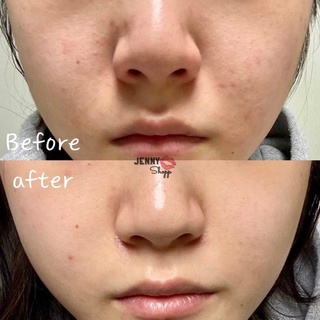 Tinh Chất Giảm Mụn Lumos Acne 5ml