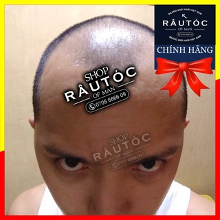 Mọc râu tóc Minoxidil 5% Foam Rogaine