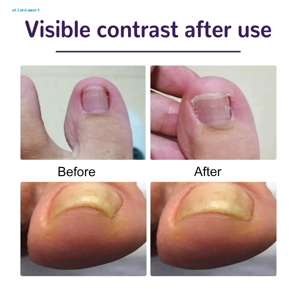 Atl| Miếng Dán Chỉnh Hình Móng Chân Mọc Ngược Tiện Dụng