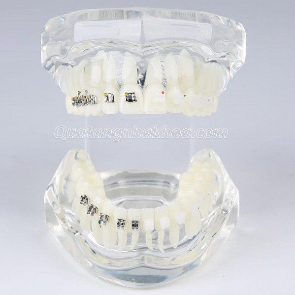 Mẫu hàm tư vấn so sánh chỉnh nha mắc cài kim loại và mắc cài sứ – mô hình nắn chỉnh răng nha khoa