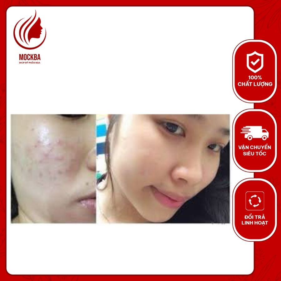 Kem mờ sẹo KLIRVIN Hàng Nga 25g, giảm sẹo lồi, lõm, sẹo thâm, do mụn, sẹo lâu năm, té ngã, sẹo non: ShopMyPhamNga_Mockba