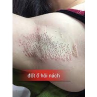 1 gói đốt ổ hôi nách dành cho spa, thẩm mỹ viện