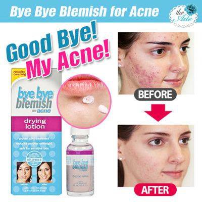 CHẤM XẸP MỤN BYE BYE BLEMISH DRYING LOTION