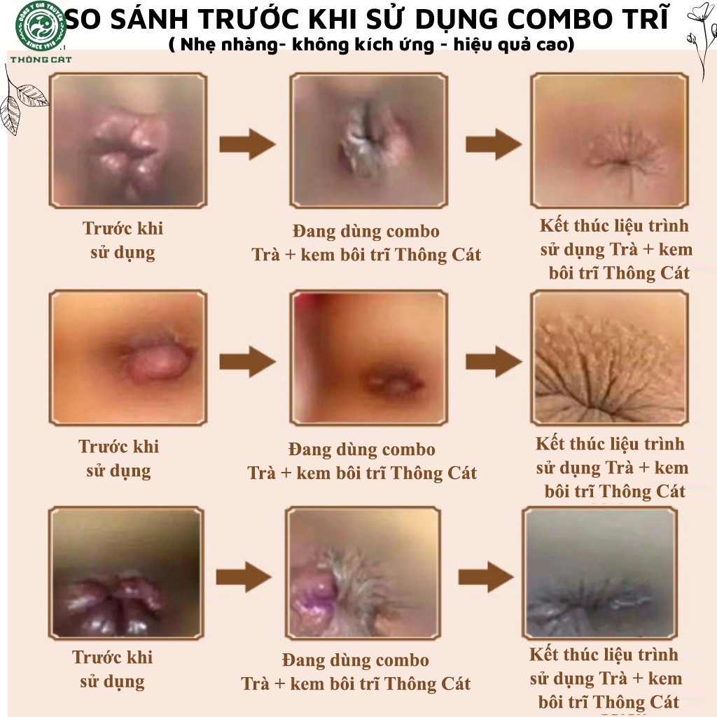 Kem Bôi và trà Trĩ Nội Ngoại ĐÔNG Y GIA TRUYỀN THÔNG CÁT HCM - Xua tan cơn đau trĩ hiệu quả