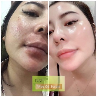 Serum NAP TREE OIL