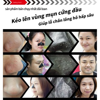 Làm sạch mụn đầu đen