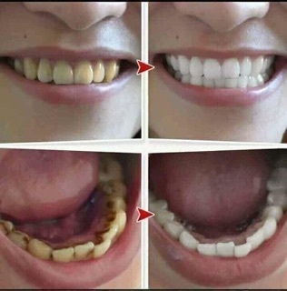 BỘT TRẮNG RĂNG TWHITE