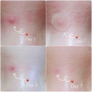 Miếng dán mụn A’pieu Nonco Tea Tree Spot Patch