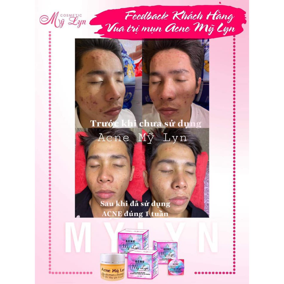 Kem Mụn Acne Mỹ Lyn Giúp Giảm Mụn, Ngừa Thâm Hiệu Qủa Sau 7-10 Ngày Sử Dụng | BigBuy360 - bigbuy360.vn