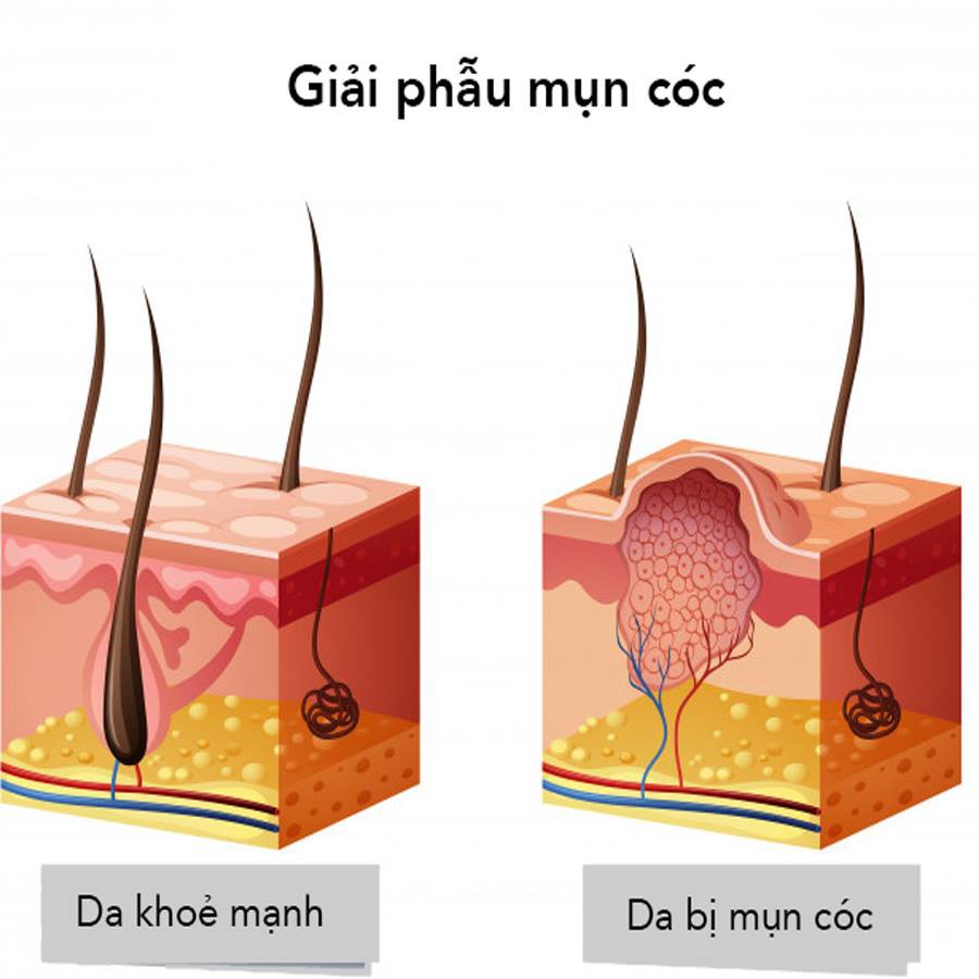 Miếng dán mụn cóc, mắt cá chân Plasters và bột tía tô để ngâm mụn - Hộp 18 miếng