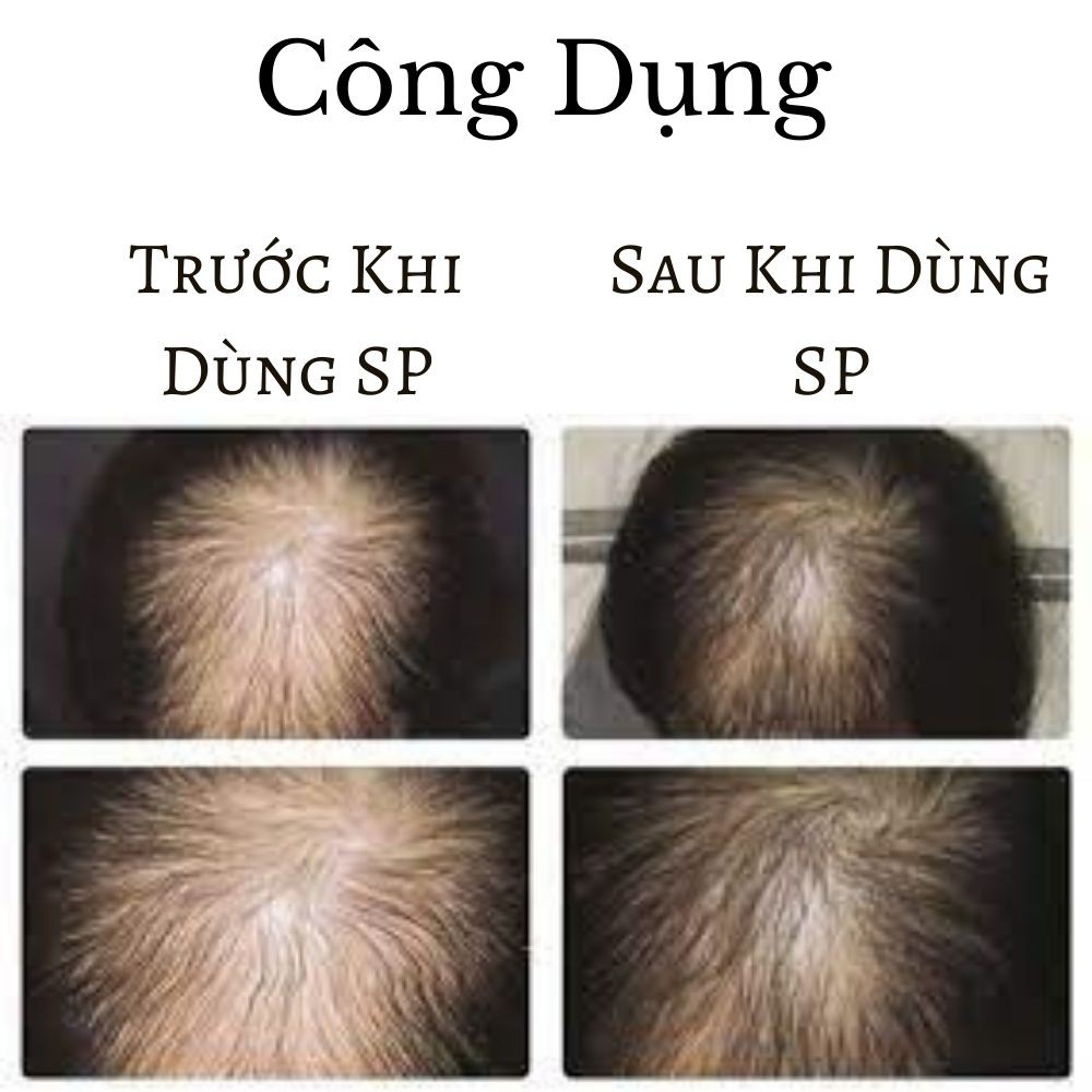 Thuốc mọc tóc Đông y gia truyền Thông Cát hiệu quả đến bất ngờ