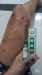 DẦU TRỊ ĐA VẾT THƯƠNG