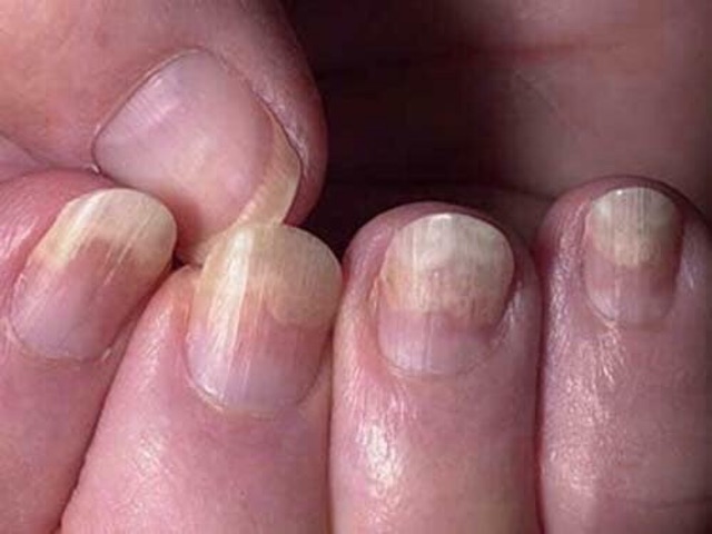 Kem Dưỡng Da Khô Vảy Nến Clinoderm Thái Lan tuýp to 15g