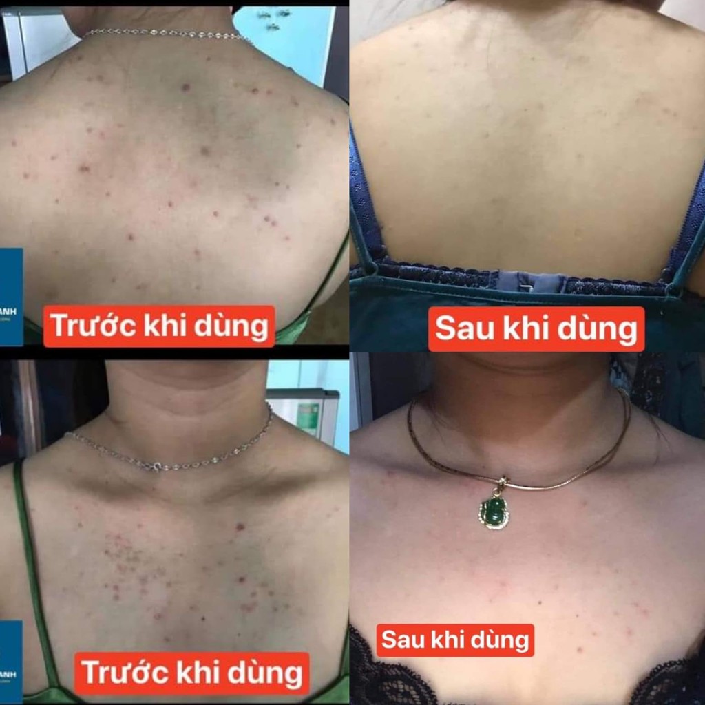 Xà Bông Mướp Đắng - Loại Bỏ Mụn Lưng Và Viêm Nang Lông - Xà Phòng Cục 130gr