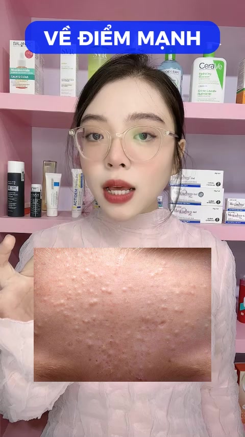 Gợi ý các mẫu sản phẩm trị mụn cho da khô