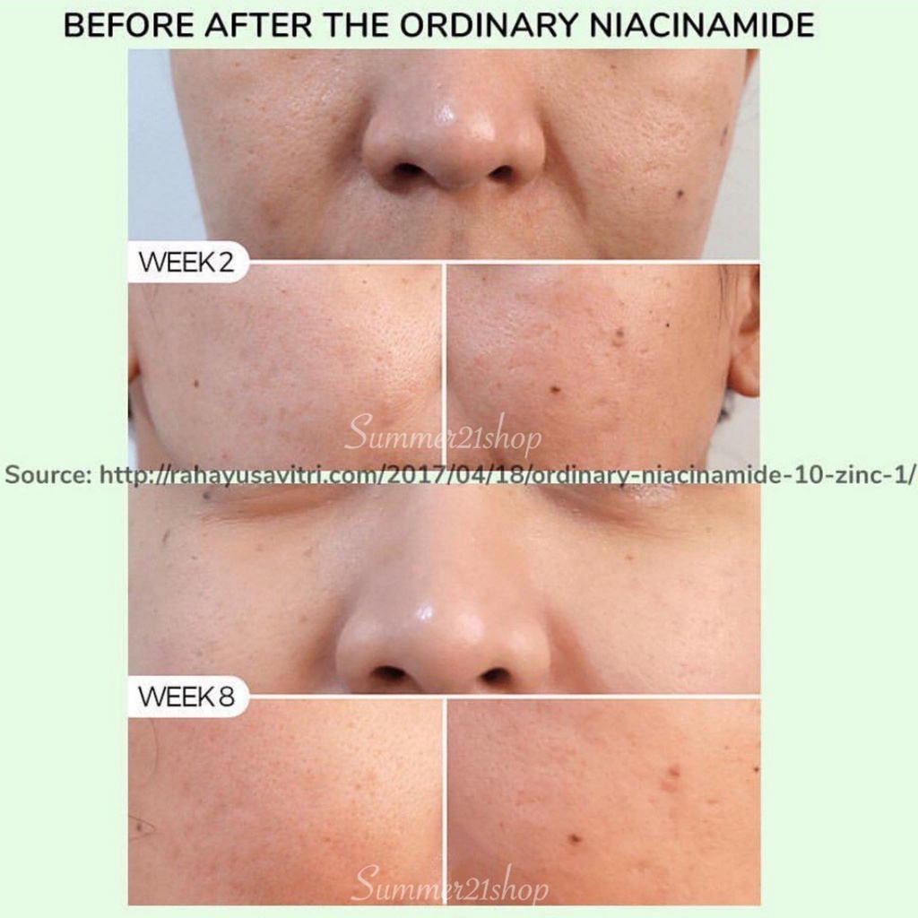 Tinh Chất Ngừa Mụn, Sáng Da, Cân Bằng Bã Nhờn, Thu Nhỏ Lỗ Chân Lông The Ordinary Niacinamide 10% + Zinc 1%