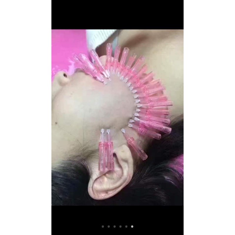 Chỉ mono- chỉ trẻ hoá- chỉ collagen