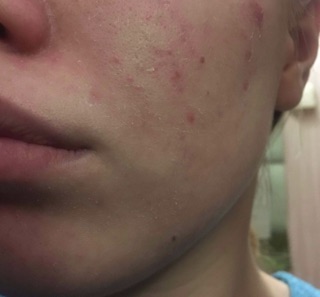 set 4 miếng pad peel thanh tẩy da Holy
