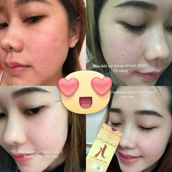 [CHÍNH HÃNG]Bật Tông Trắng Hồng&amp;Giảm Thâm  - Serum Kiều Beauty Queen (10ml)